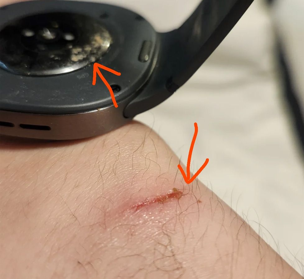 Lesión cutánea en la muñeca junto a la base de un reloj inteligente con marcas de quemadura señaladas por flechas rojas.