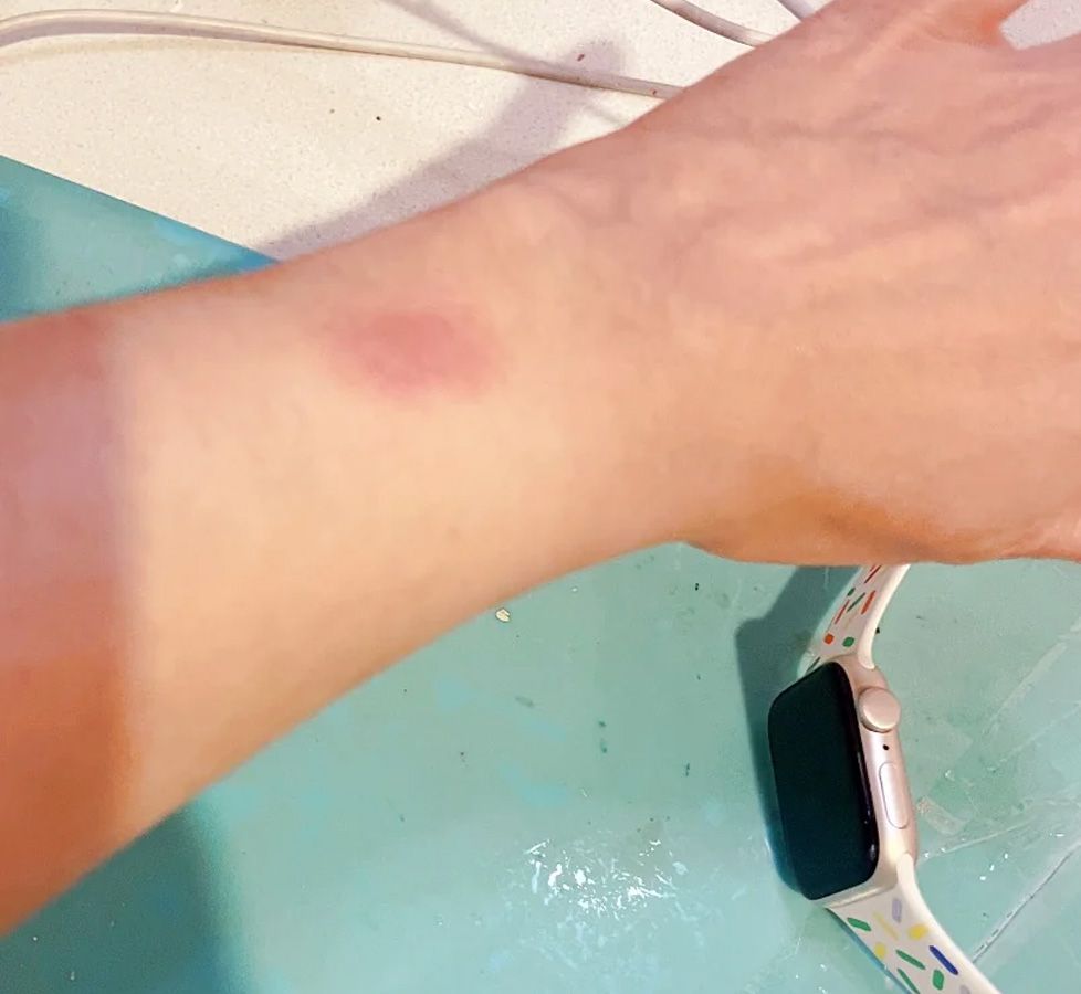 Irritación cutánea circular en la muñeca junto a un Apple Watch con correa blanca estampada.